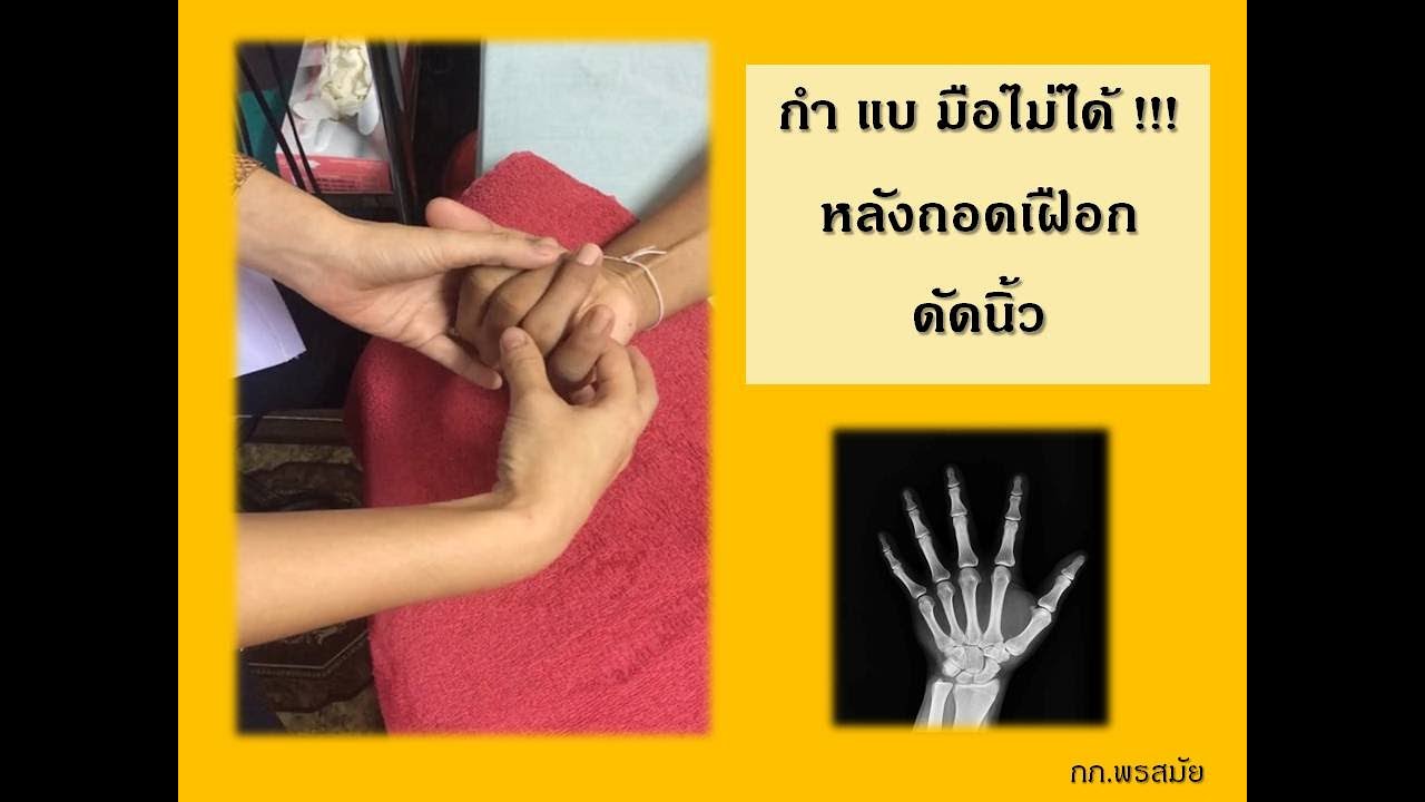 กายภาพบำบัดหลังถอดเฝือกนิ้วมือ