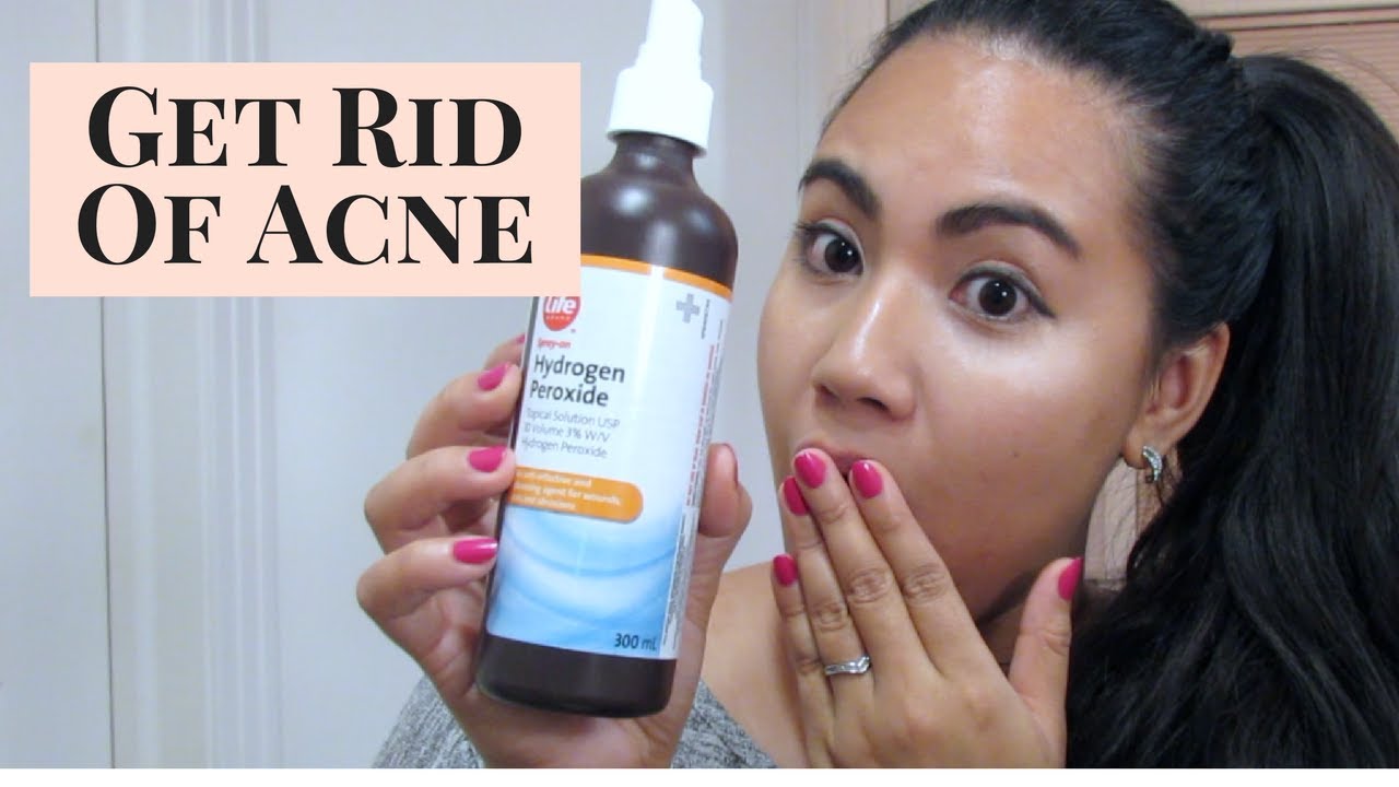 How to treat your acne using hydrogen peroxide?