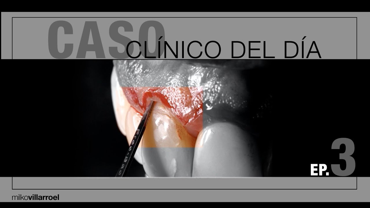 Unificar el material restaurador l #CasoClínicoDelDía l Milko Villarroel