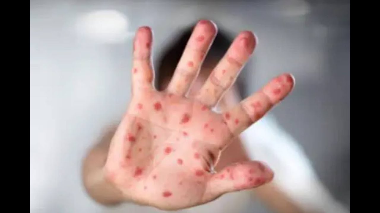 Minsa emite alerta epidemiológica ante alto riesgo de sarampión y polio