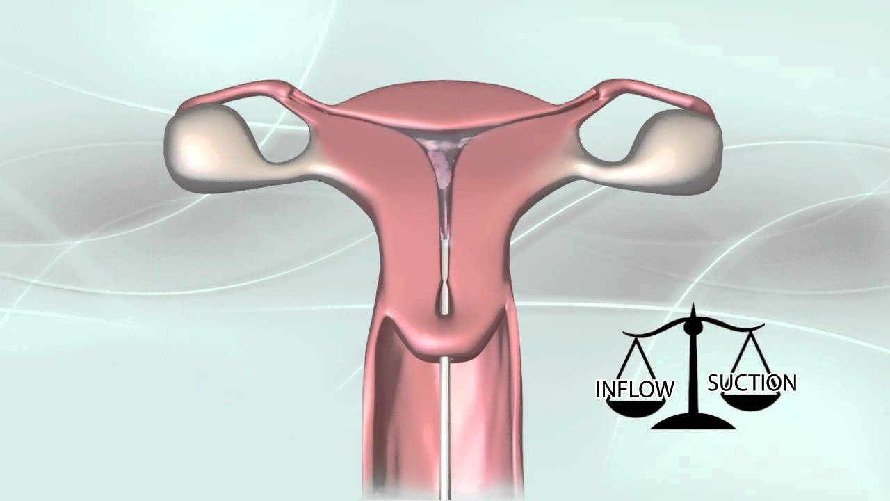 MyoSure tissue removal procedure animation