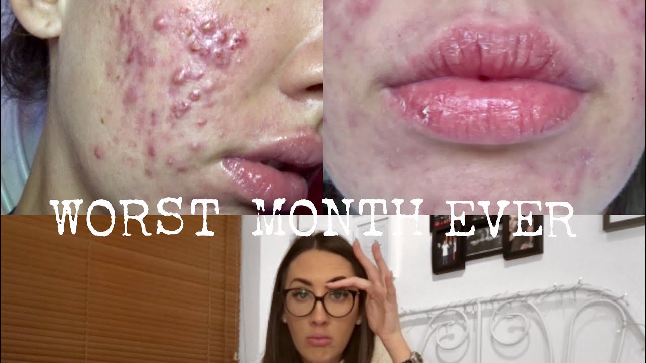 My Roaccutane Experience | MONTH TWO | Sarah Jennings