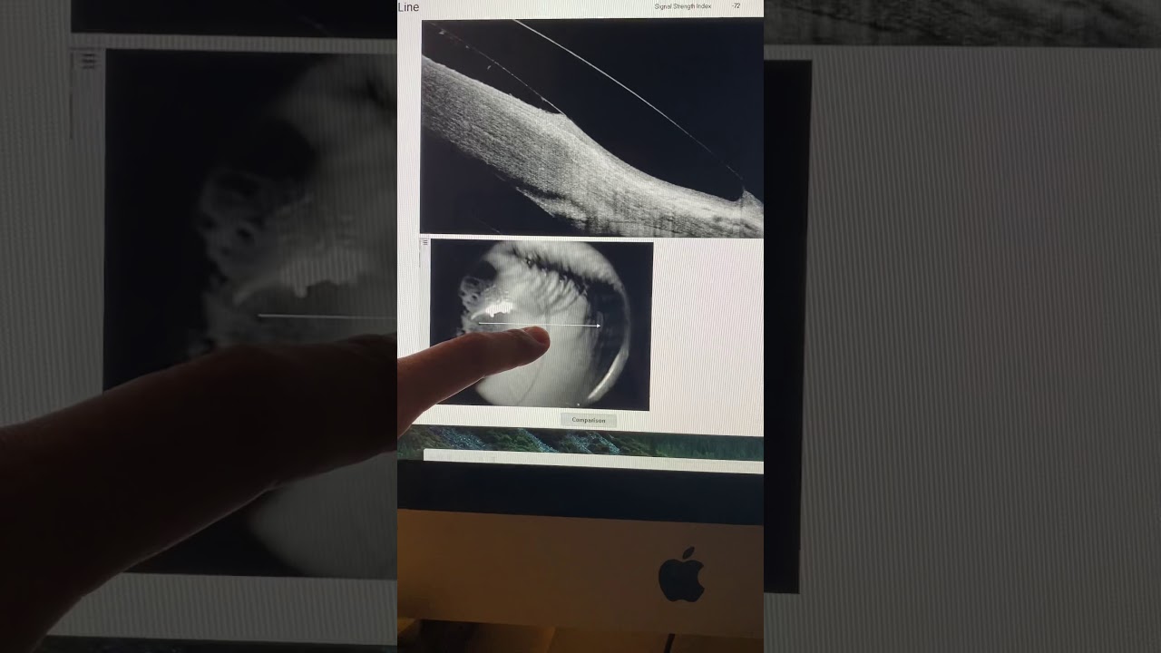 How to avoid corneal transplantation in severe keratoconus: a case example Kanellopoulos, MD
