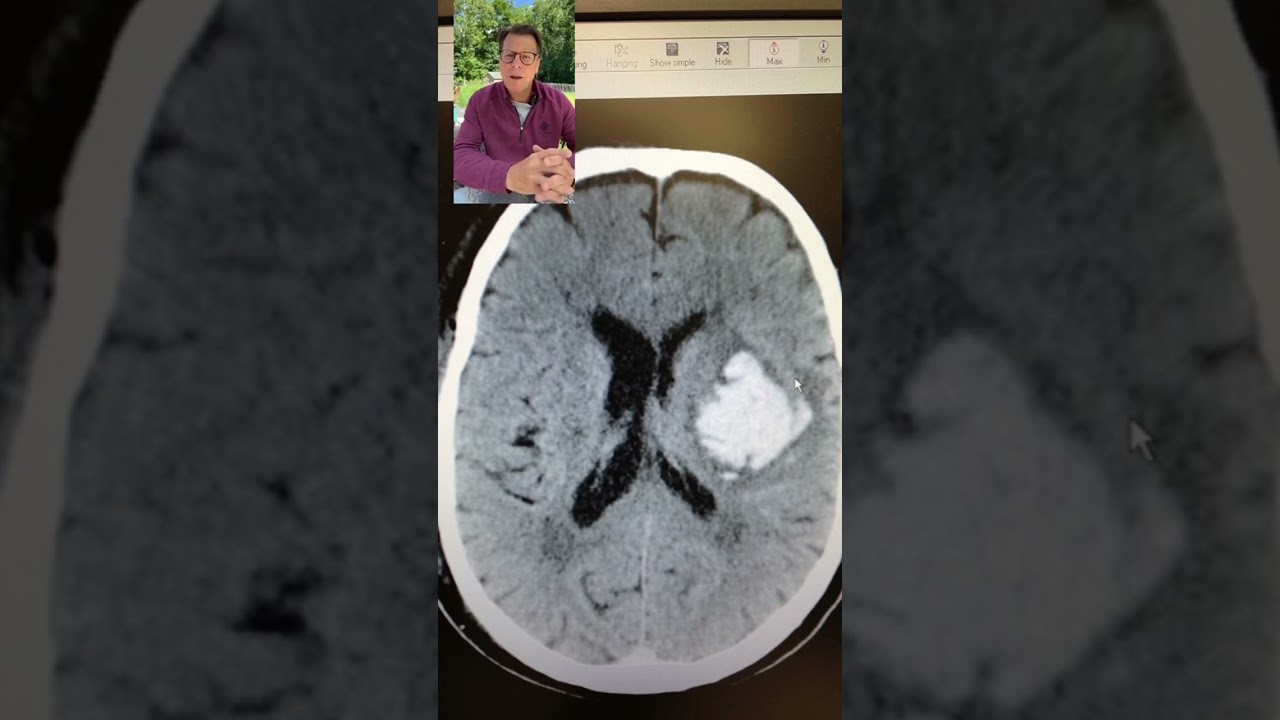 Neurosurgeon explains what blood looks like in the brain on a CT scan #brain #shorts