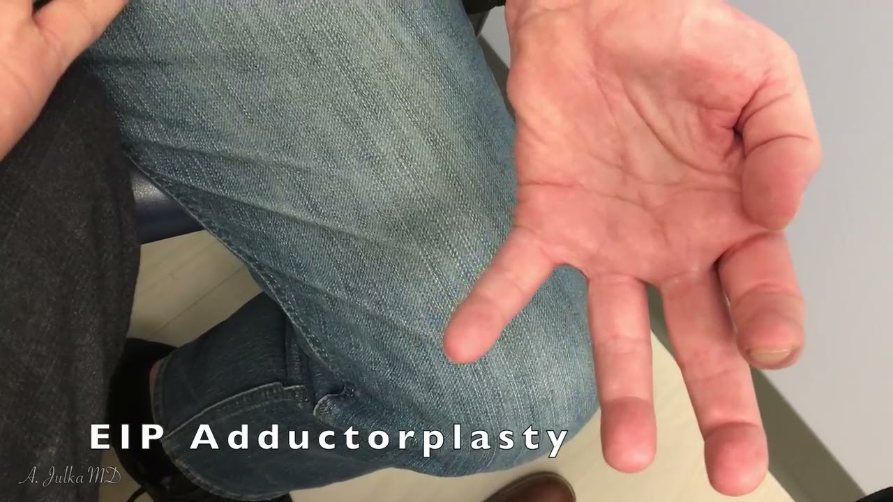 Tendon Transfer Surgery Post Operative Recovery for Claw Hand