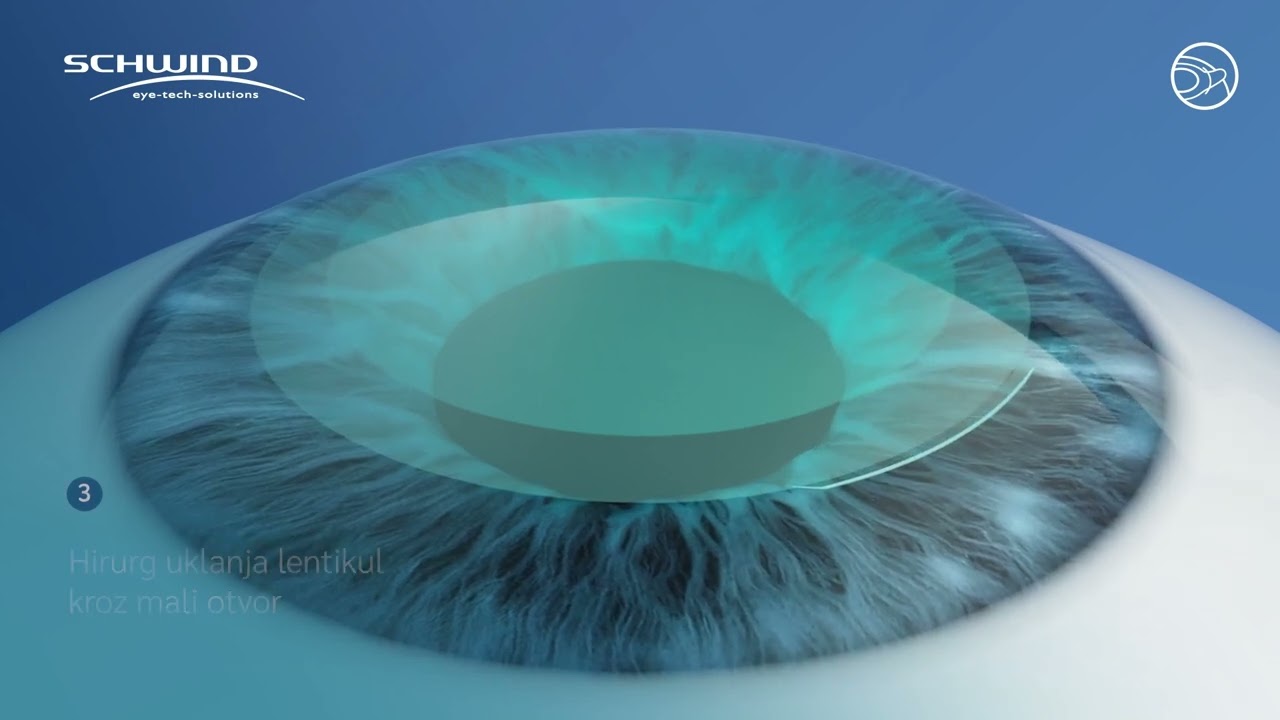SmartSight lasersko skidanje dioptrije