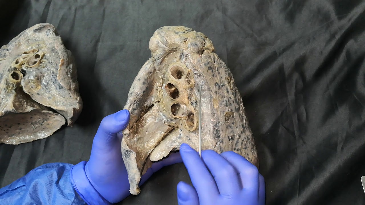 PULMONES - ANATOM&Iacute;A DE TORAX.