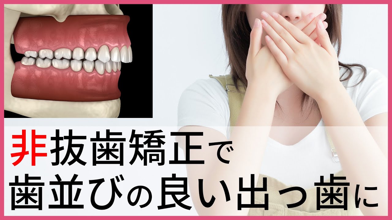 【非抜歯矯正で失敗】歯並びの良い出っ歯になって再治療