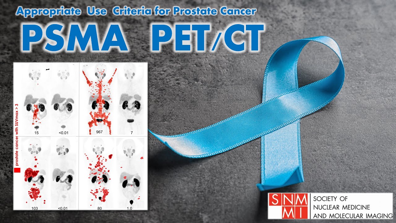 PSMA PET/CT Imaging | Appropriate Use Criteria | SNMMI