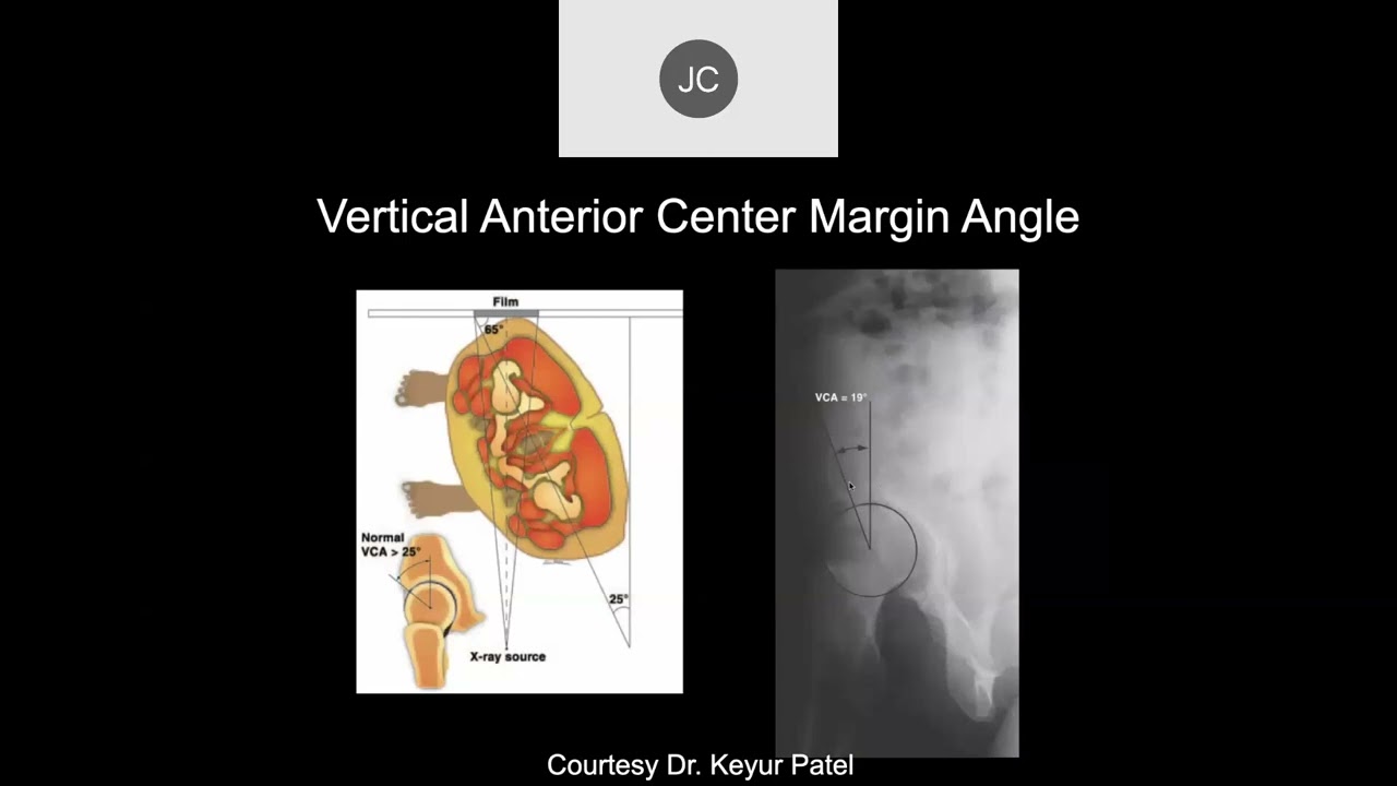 MRI of the Hip, Part 1 – Hip AVN
