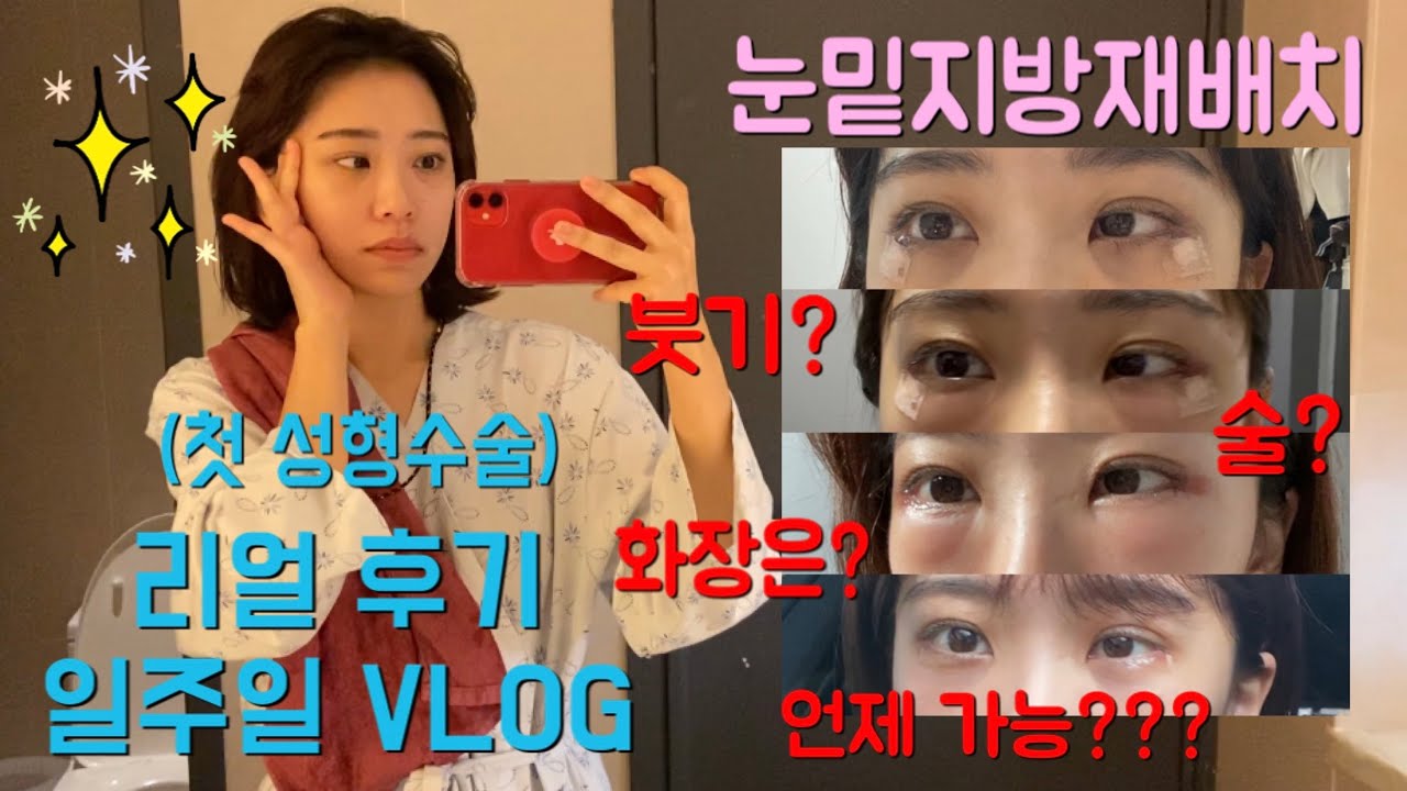 [일상Vlog] ⭕️내돈내한⭕️ 눈밑지방재배치(+눈밑당김) 리얼 후기 1탄 ⭐️ 일주일 붓기 , 멍 과정 일주일동안 상세하게 찍어봄 ‼️ 내 인생 첫 성형수술 후기에용 (혐오주의)