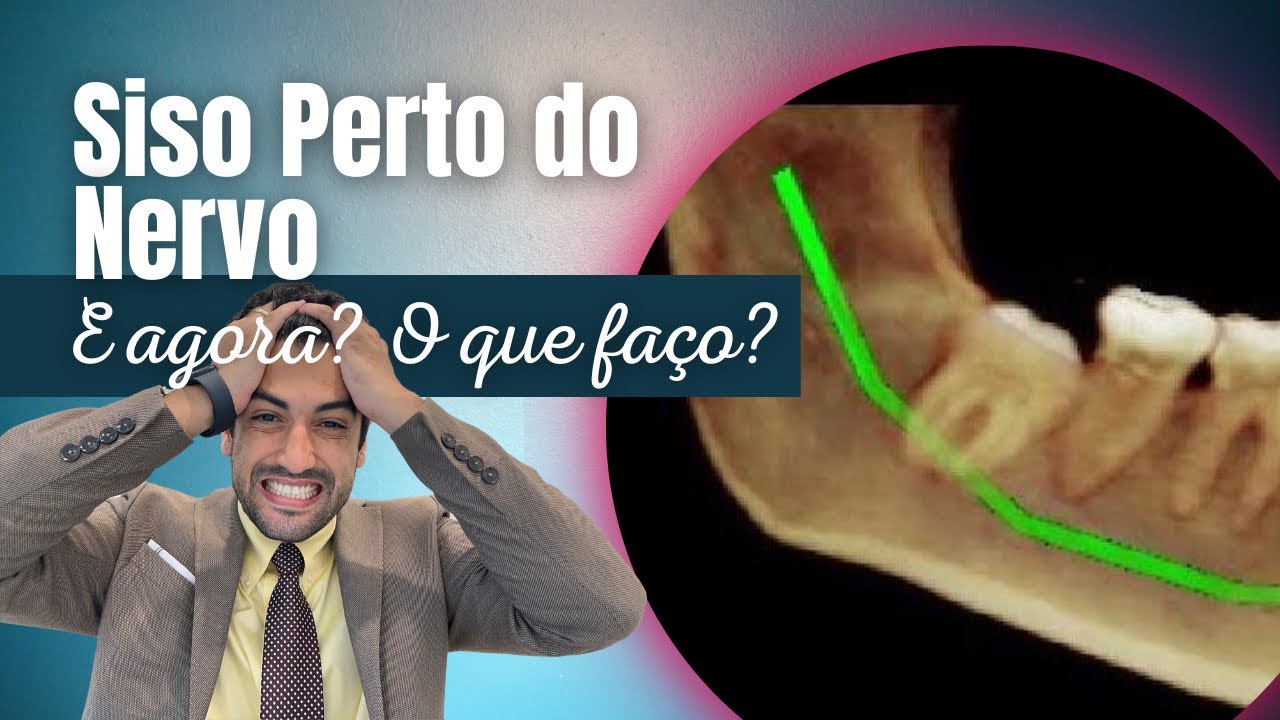SISO PERTO DO NERVO! Extrair ou Não?