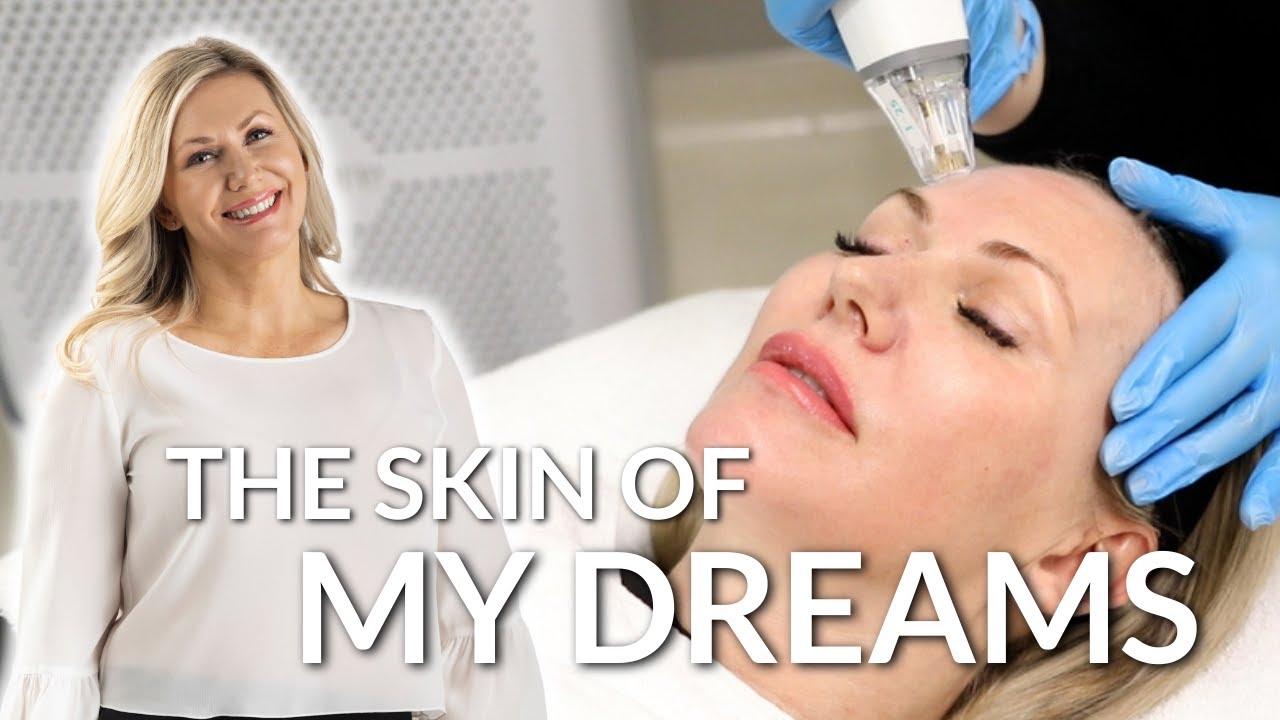 This treatment CHANGED my skin!!! Microneedling & radiofrequency...the latest technology for skin!