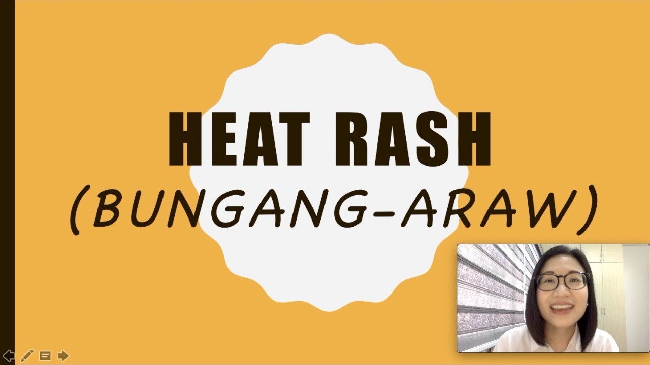 How to Deal with HEAT RASH or Bungang Draw | Dr. Kristine Kiat