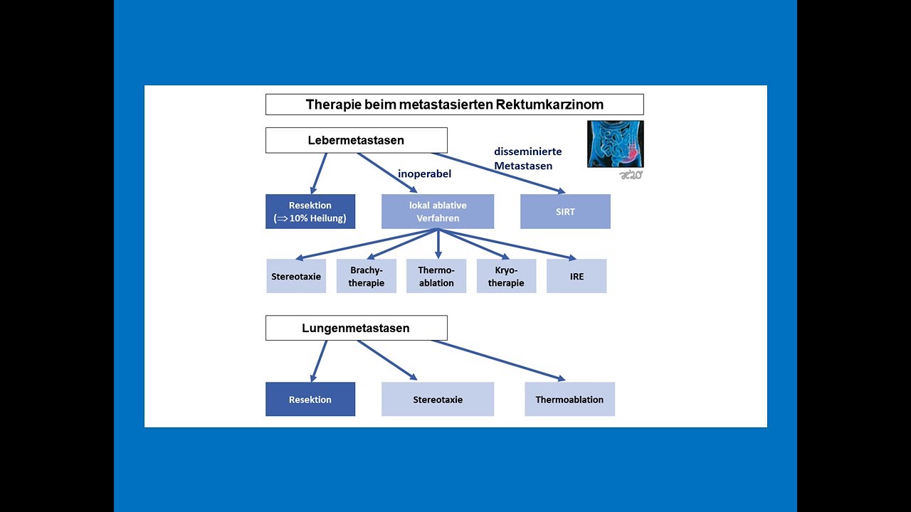 Therapie beim metastasierten Rektumkarzinom | Strahlentherapie Prof. Hilke Vorwerk