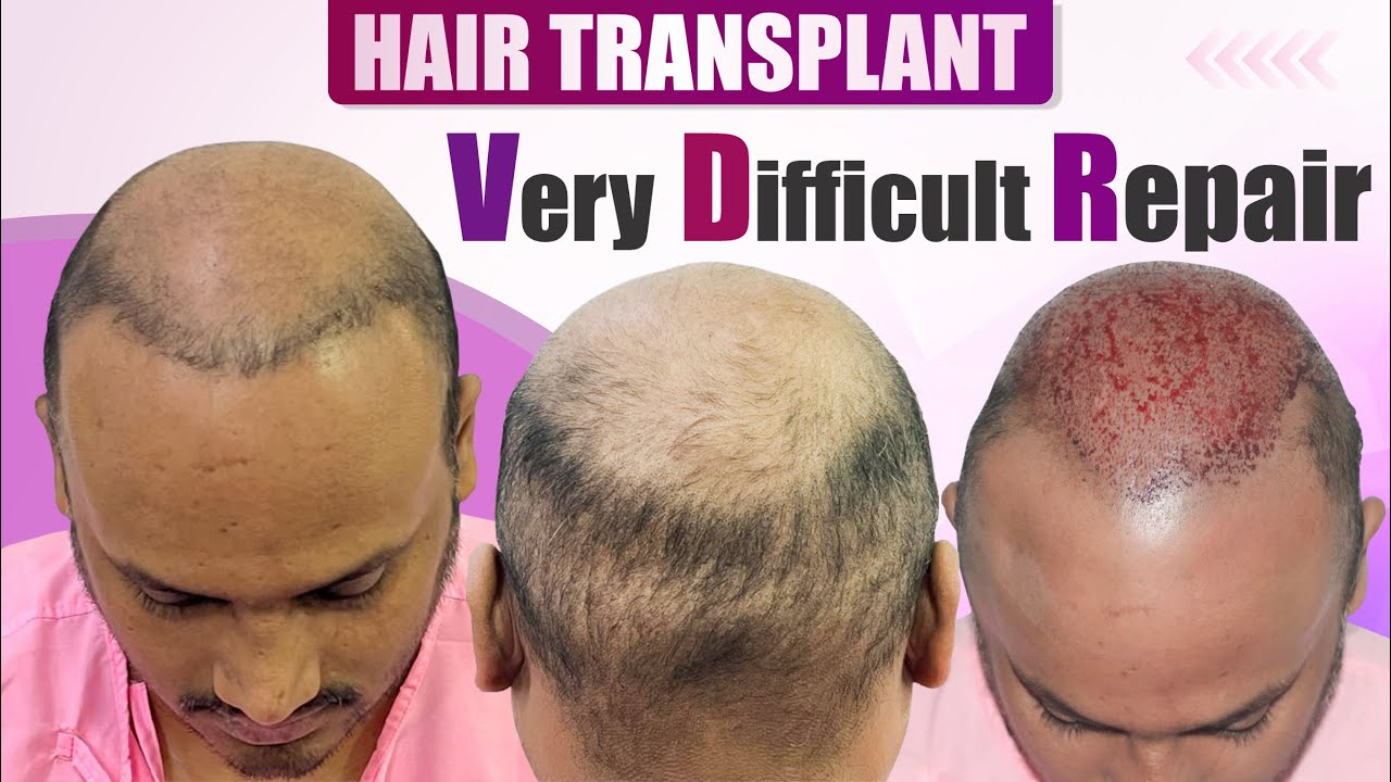 Difficult Hair Transplant Repair 4000 Grafts | Very thin Donor Area | Dr Suneet Soni | Medispa