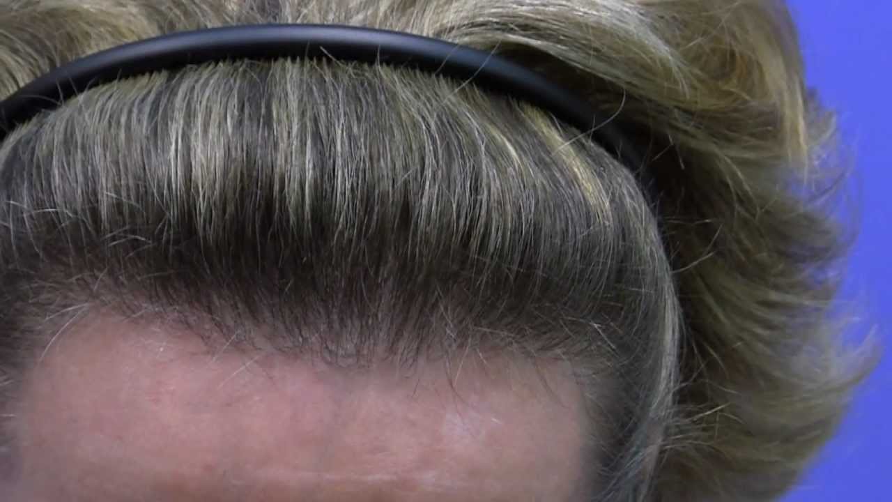 Female Frontal Hairline Restoration - Dr. Gabel, Portland, Oregon