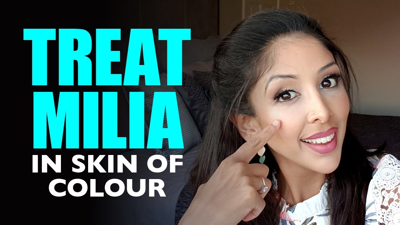 MILIA- How to treat & prevent |Dr V