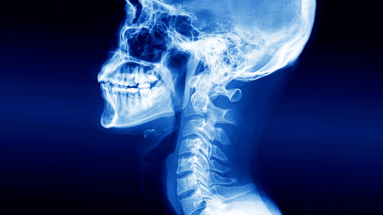A Man Swallowed Wireless Earbud. This Is What Happened To His Esophagus.