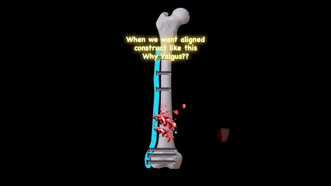 Issue of Valgus Mal-reduction in Distal femur plating #fracture #ortho