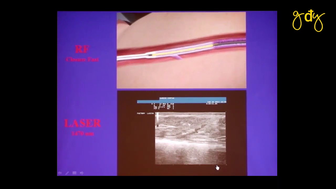 CẬP NHẬT CÁC PHƯƠNG PHÁP CAN THIỆP ĐIỀU TRỊ SUY TĨNH MẠCH MẠN TÍNH CHI DƯỚI | BS. NGUYỄN TUẤN HẢI