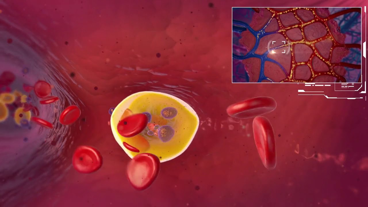 Gubert Lipiodol