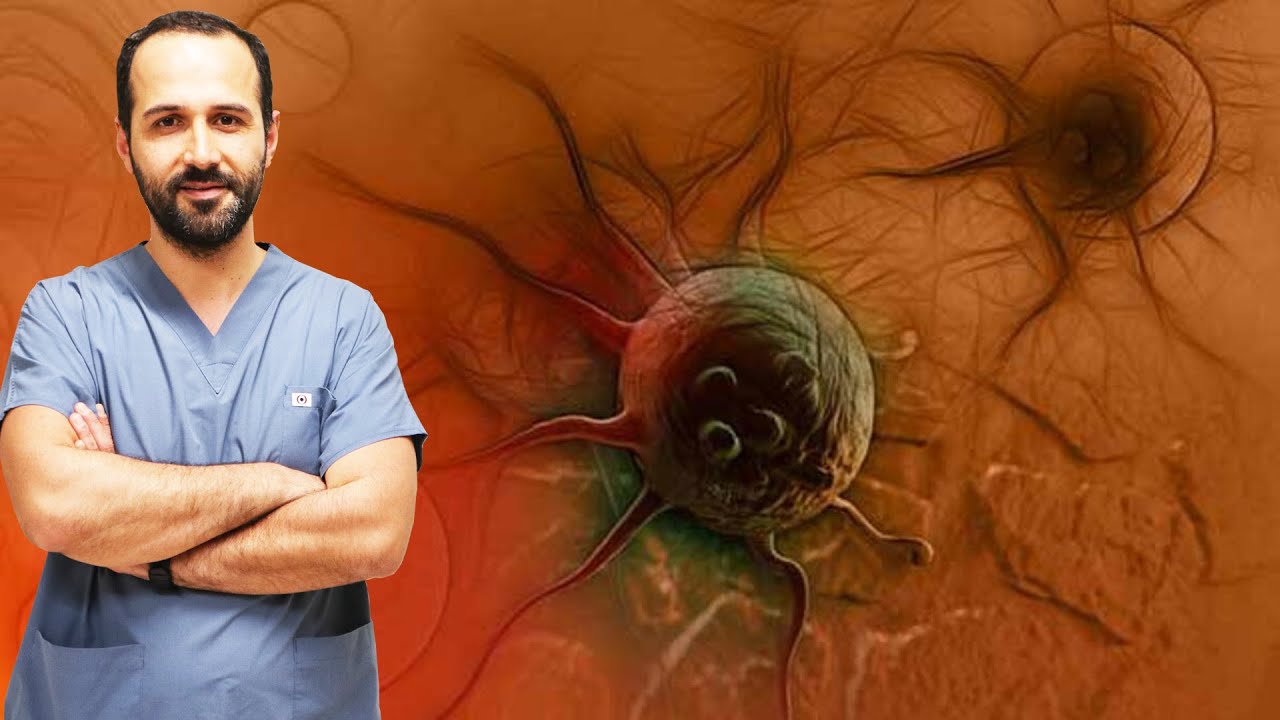 Mide Kanseri Belirtileri ve Tedavi Yöntemleri Nelerdir? - Doç. Dr. Hakan Demirci