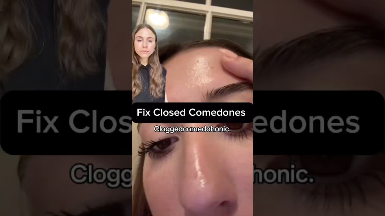 Get Rid of Closed Comedones FAST 🔥 #dermatologist