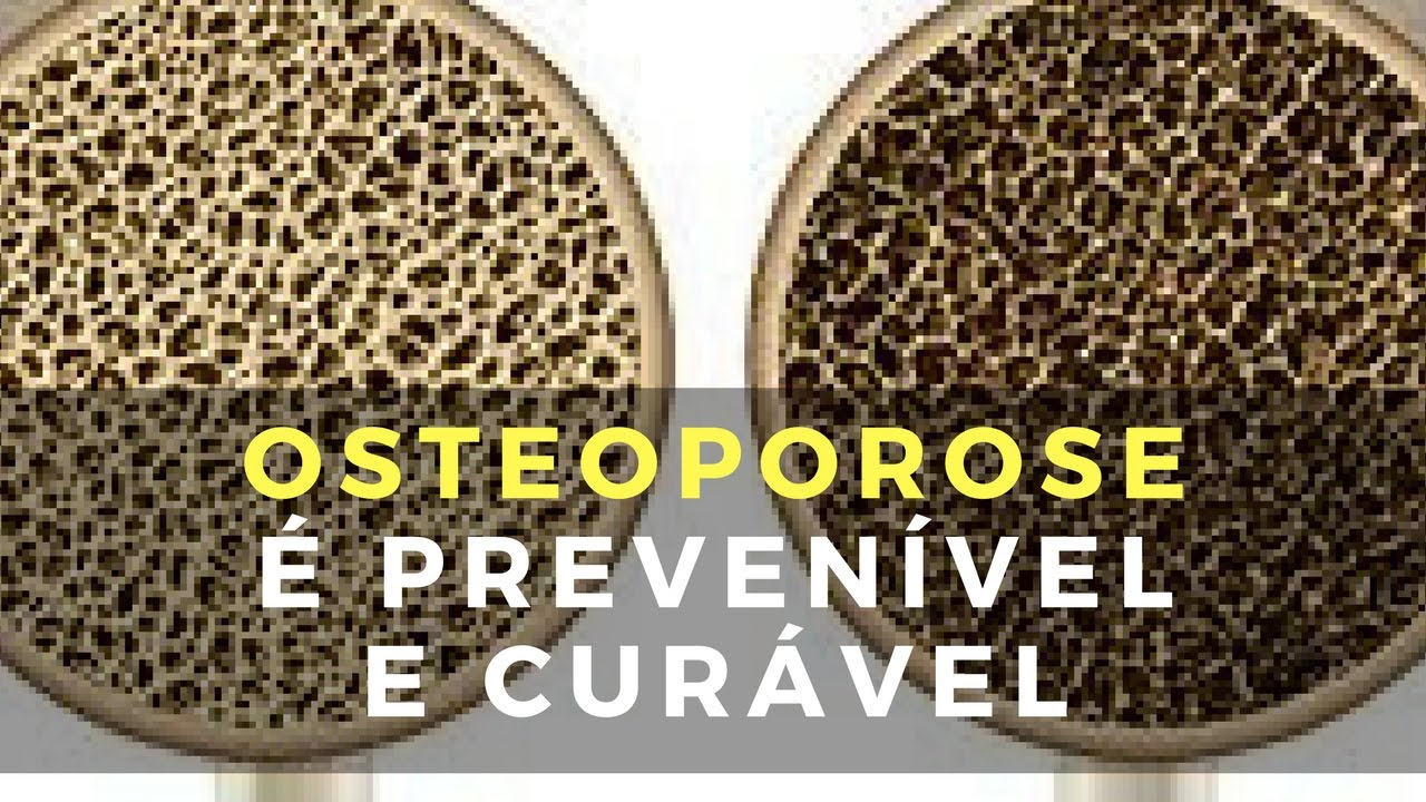 Osteoporose É Prevenível e Curável
