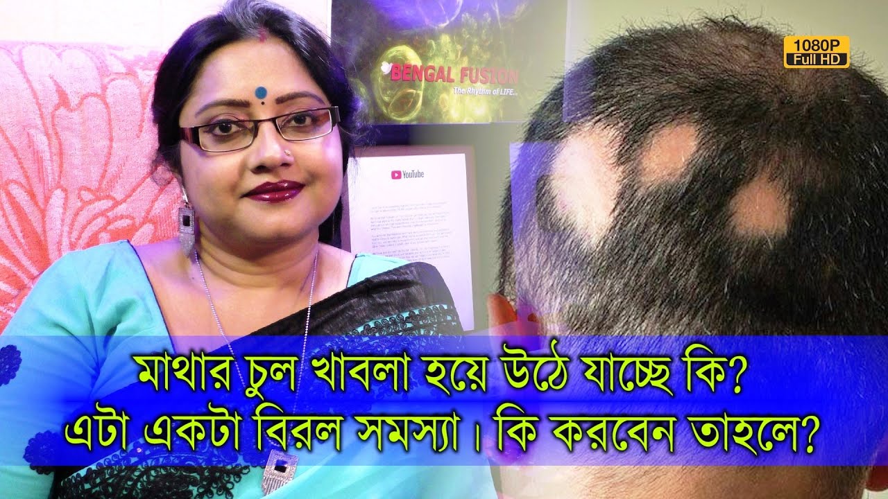 মাথার চুল খাবলা হয়ে উঠে যাচ্ছে কি? এলোপেসিয়া নয়তো? এই বিরল সমস্যায় কি করবেন জেনে রাখুন। | EP 983