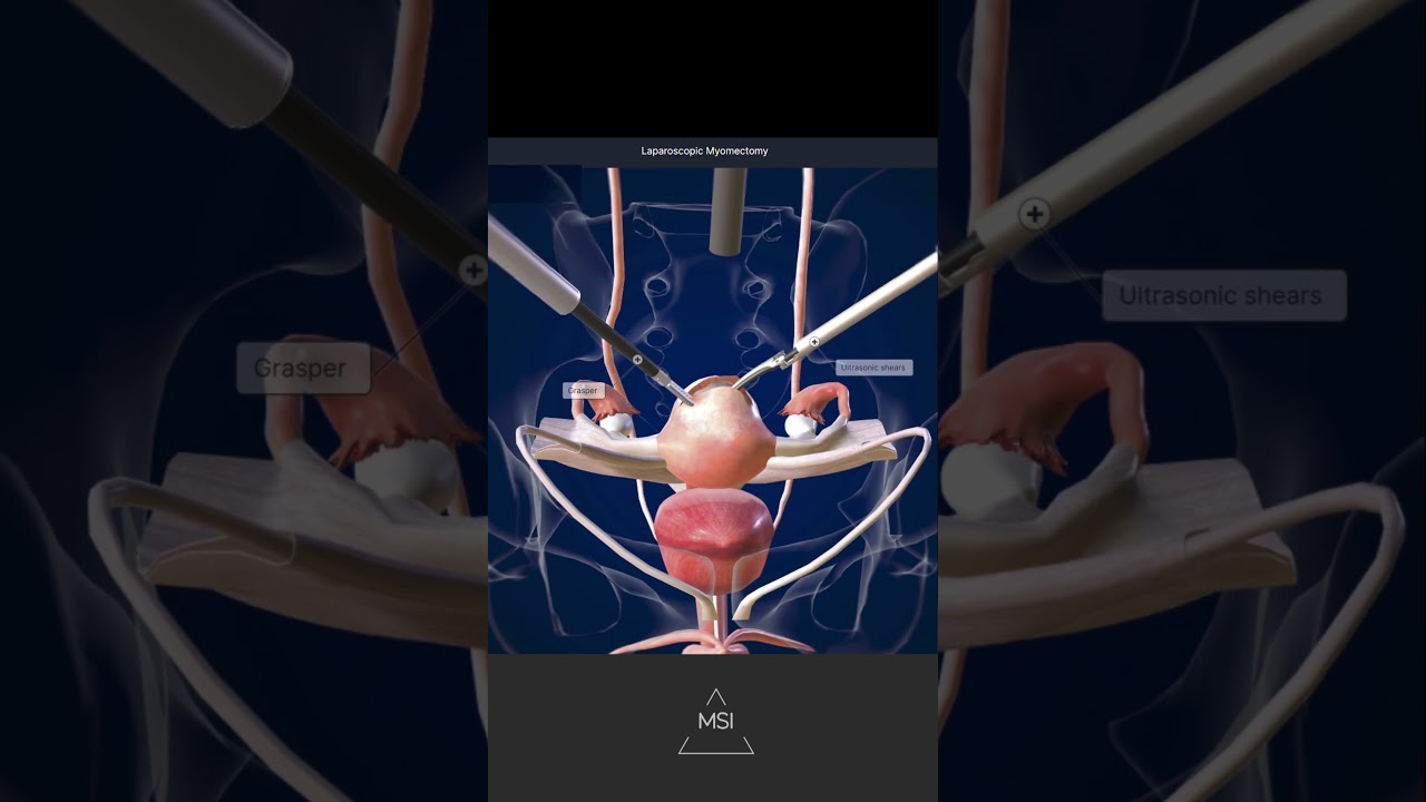 Laparoscopic Myomectomy