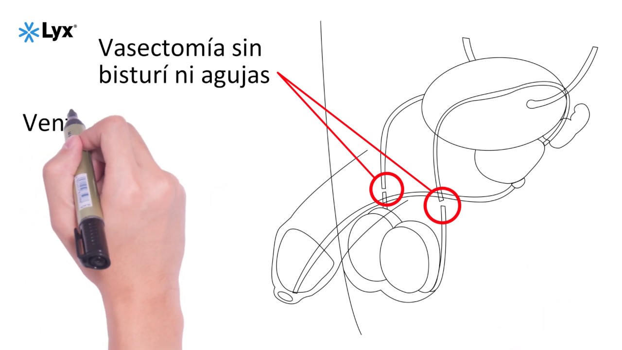 Vasectom&iacute;a sin bistur&iacute;