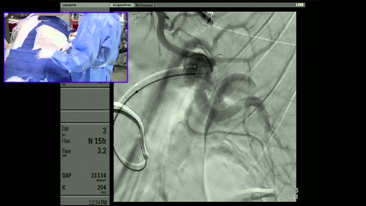 Transradial Embolization of a Splenic Artery Aneurysm - Part 2: Embolization - 10 min cut