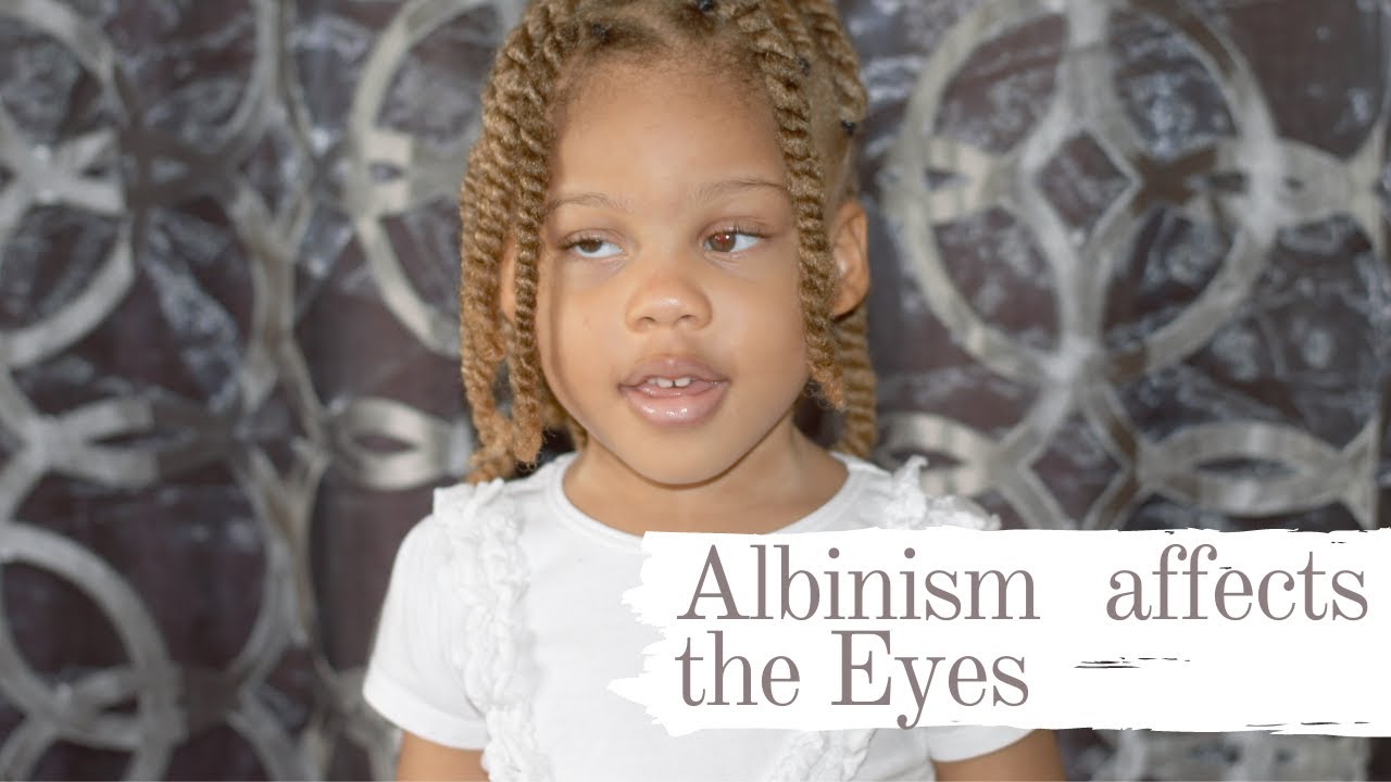 Common Eye Problems Found in Persons with Albinism