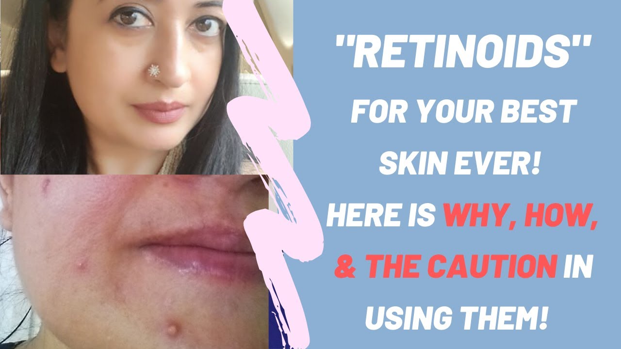 Retinoids 101: Retinoid Dryness, Redness| How to use Retinoid | Retinol India