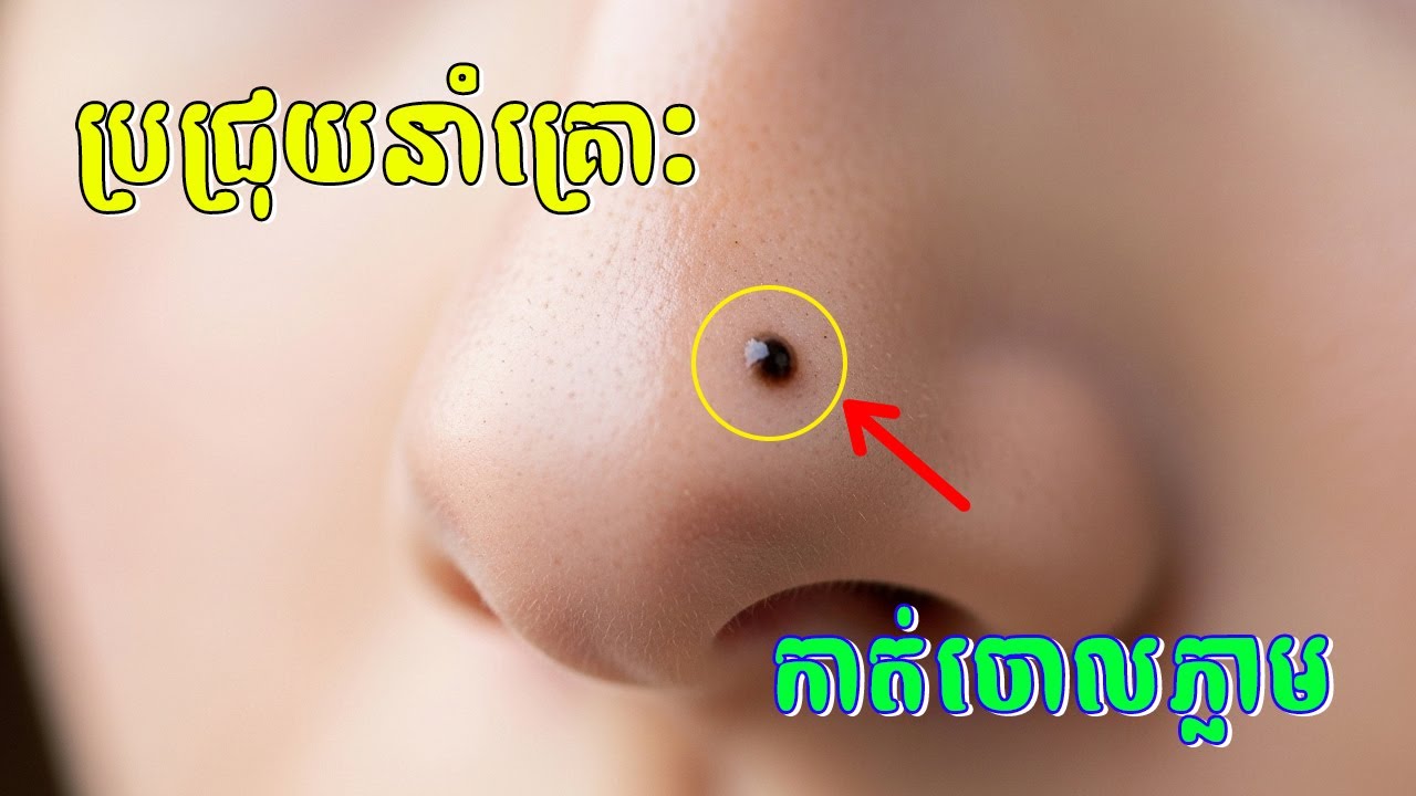 ប្រជ្រុយទាំង ៣ កន្លែងនៅលើផ្ទៃមុខបំផ្លាញទ្រព្យ និងកាត់បន្ថយលាភសំណាងរបស់ម្ចាស់