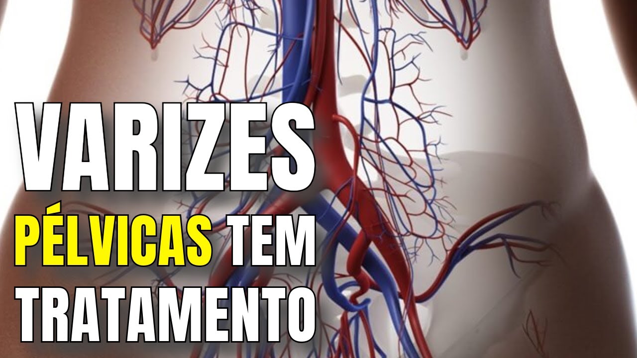 Varizes P&eacute;lvicas: o que s&atilde;o? o que fazer? como tratar? d&aacute; para engravidar?  Varizes na vagina?