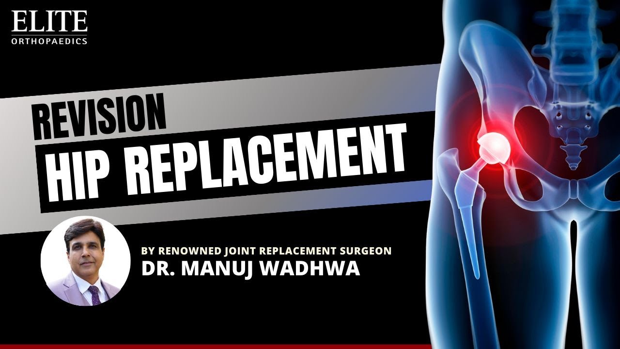 Revision Total Hip Replacement: Comprehensive Guide | Dr. Manuj Wadhwa