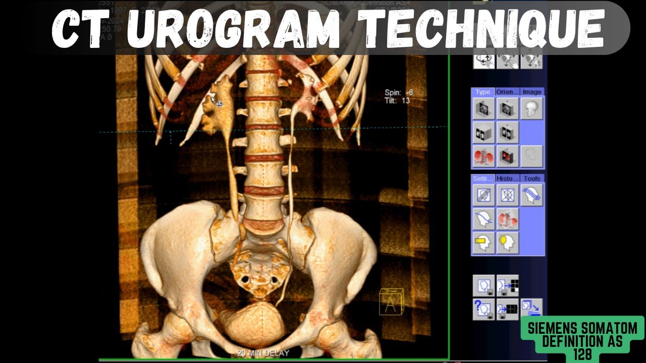 CT Urogram Techniques | Phases of CT Urography | CT IVU |CT Scan Practical Tutorial | SIEMENS CT |