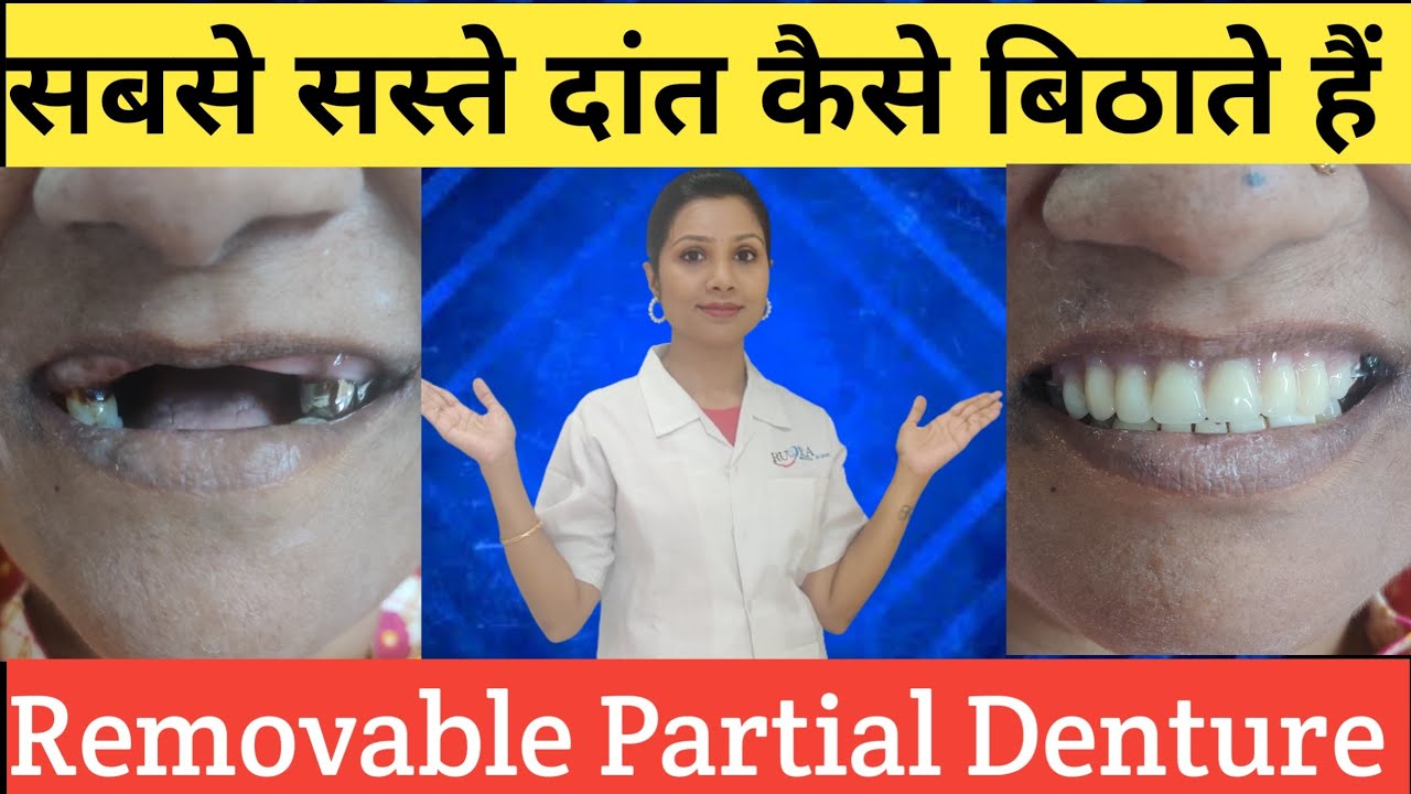 सबसे सस्ते दांत |निकालने पहनने वाले दांत |Removable Partial Denture |Naye Dant Lagane Ka Tarika