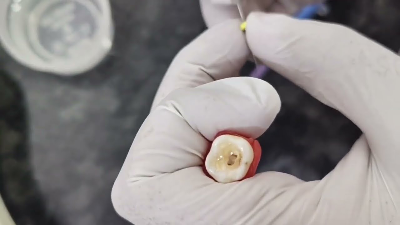 HOW TO DO MOLAR RCT