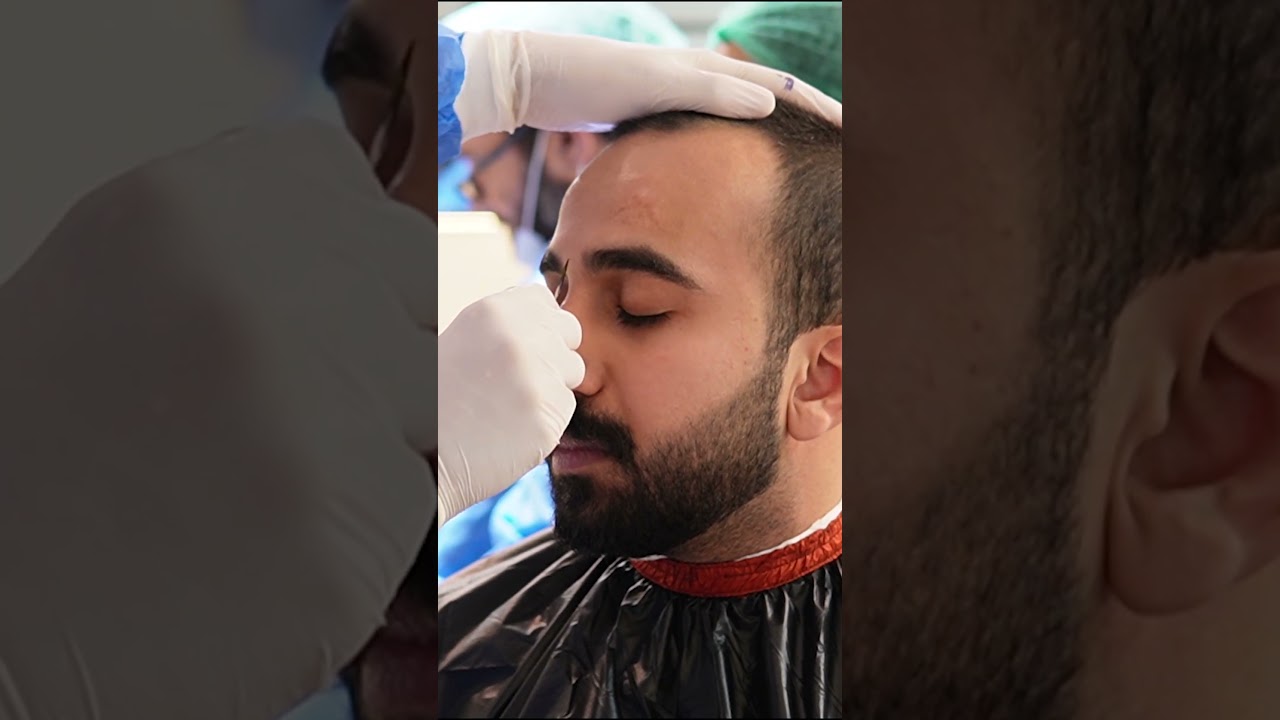 Today's procedure at Hair Club: FUE Hair Transplant with DHI technology.