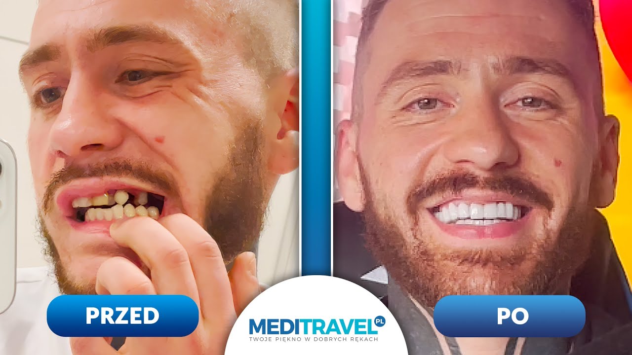 Niesamowita Metamorfoza Piotra - Hollywood Smile w Turcji