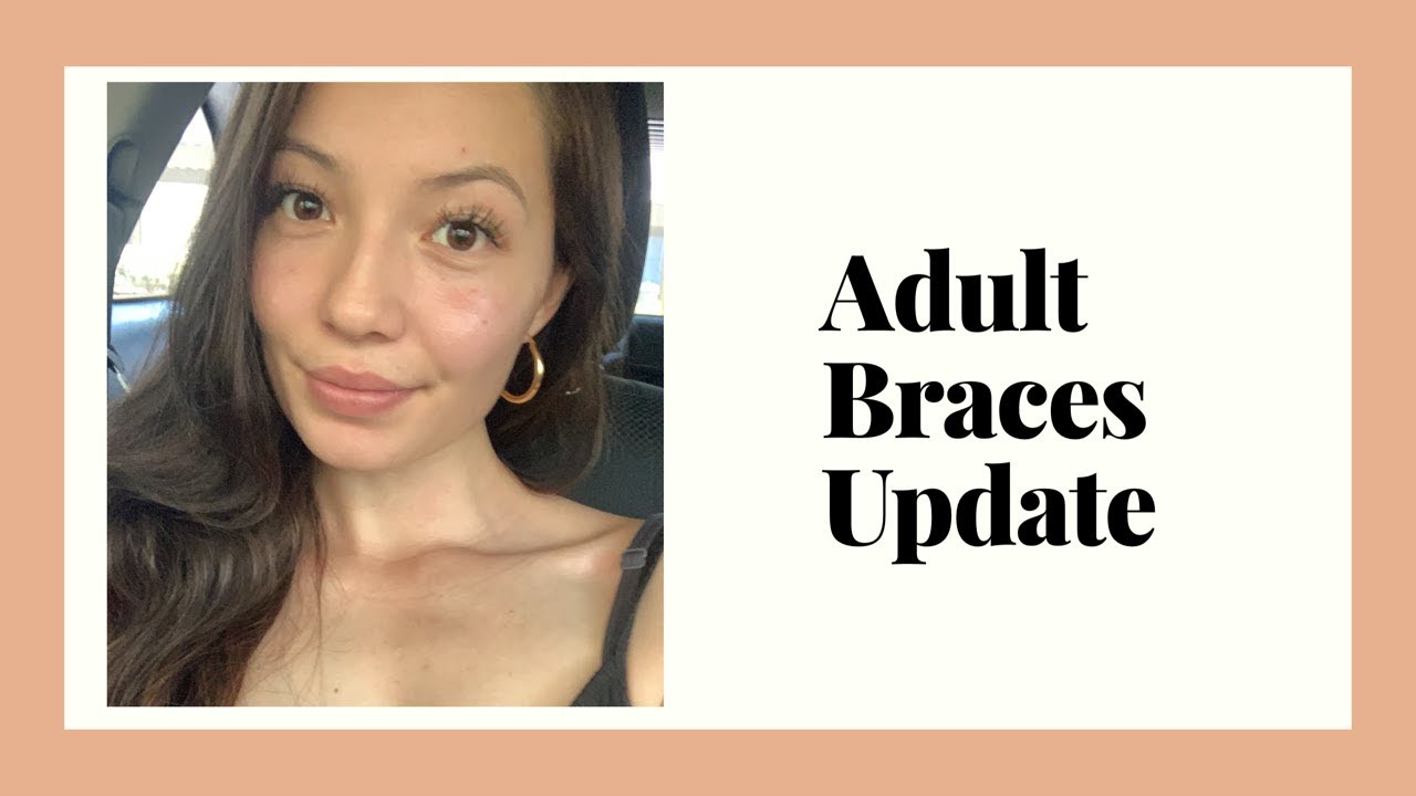 Adult Braces update || Deep bite, Overjet, and Jaw surgery