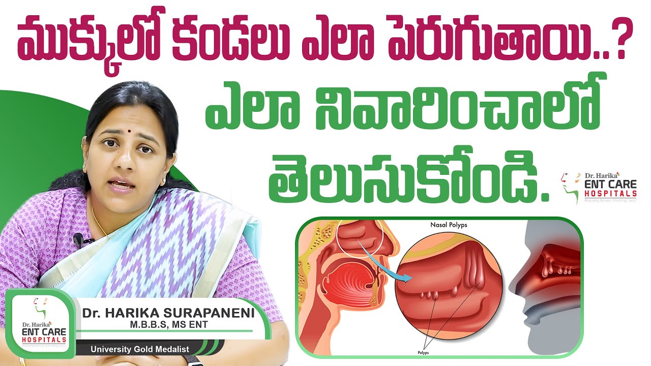 How to Treat Nasal Polyps | Diagnosis and Treatment of Nasal Polyps | Dr Harika ENT Care Hospital