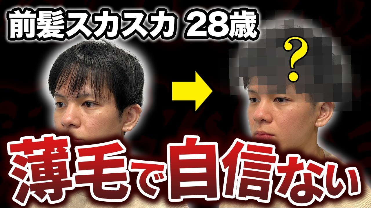 【初登場!!】薄毛で自信を失った28歳男性がヘアセットでイケメンに大変身！