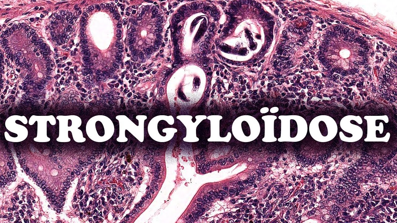 LA STRONGYLOÏDOSE (L’ANGUILLULOSE) - PATHOLOGIE