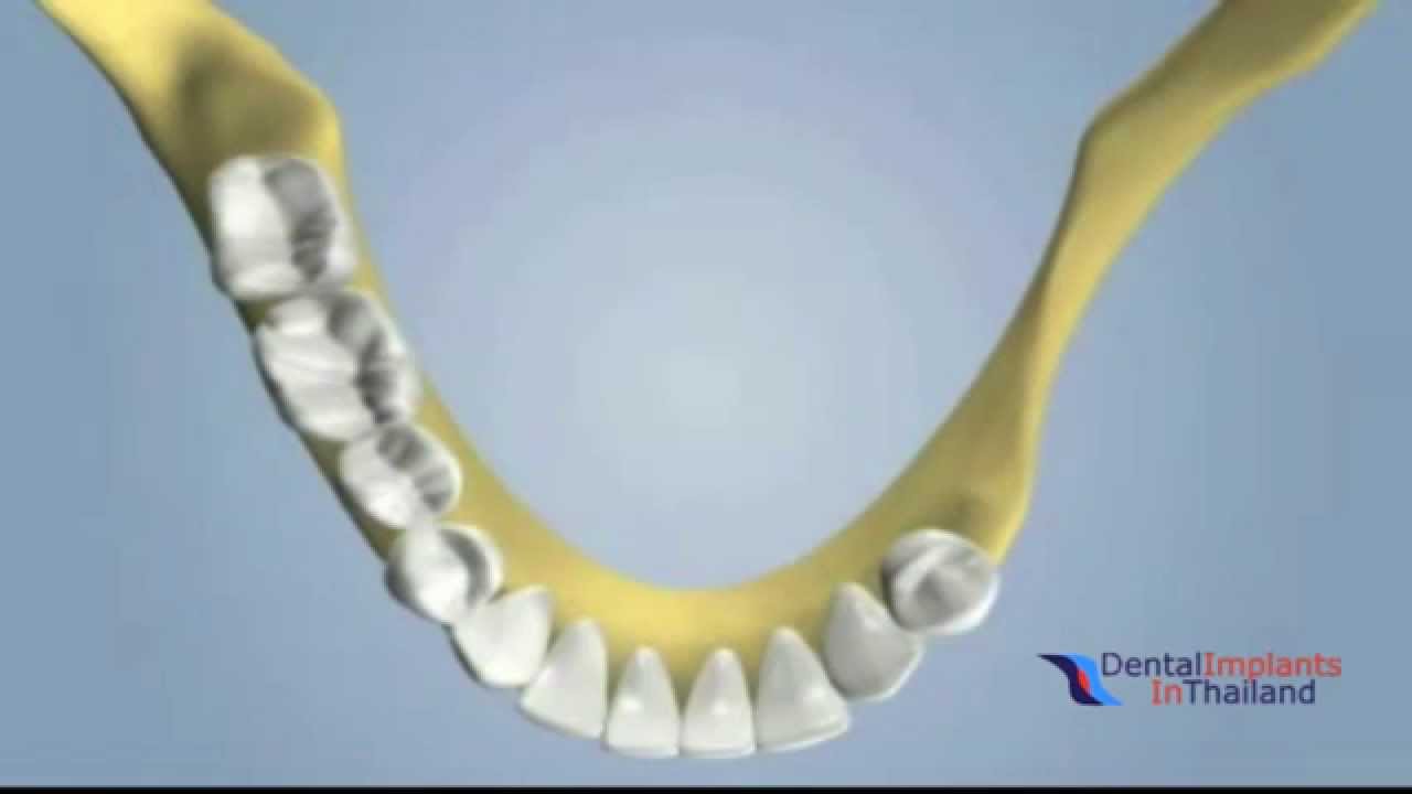 Dental Grafting Block Autografting Using Localized Ridge Augmentation @ Dental Center of Thailand