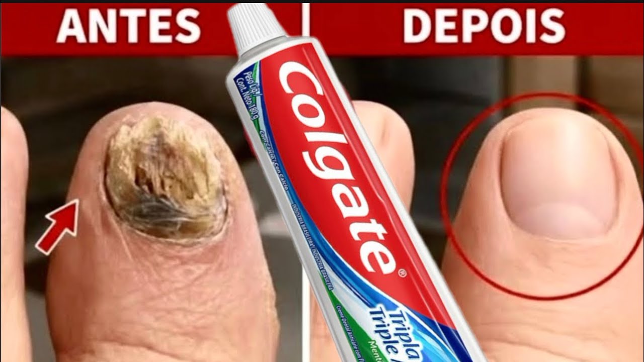 Minha unha estava PODRE e nenhuma manicure quis mexer &mdash; isso agiu em 2 DIAS. 