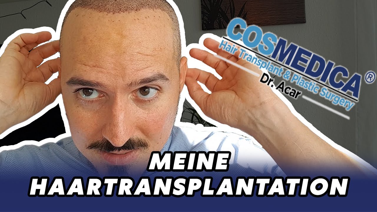 Meine Erfahrungen - Haartransplantation